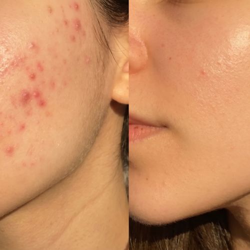 Skin Anti-Akne Cold Plasma
