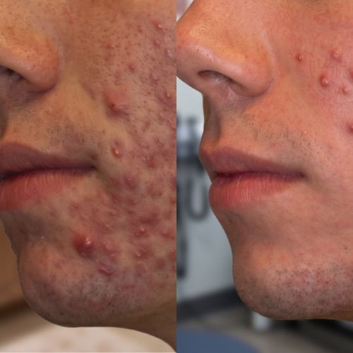 Skin Anti-Akne Cold Plasma
