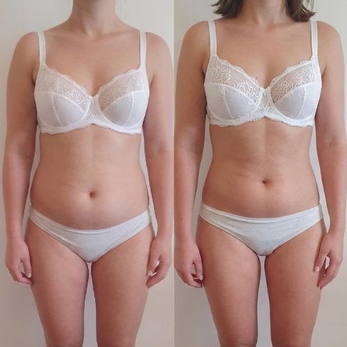 Body Shaping Fettzellenabbau