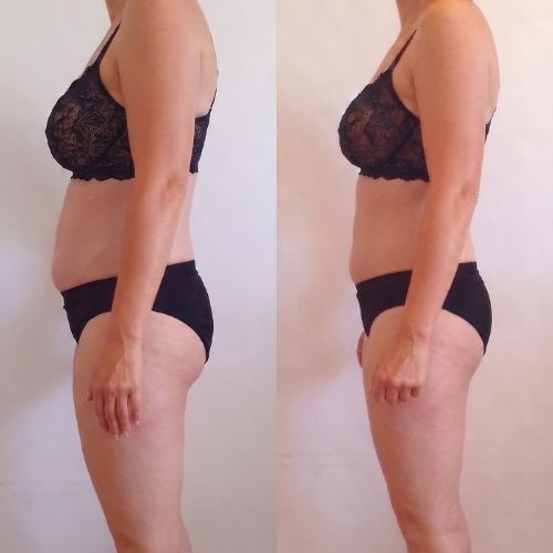 Body Shaping Fettzellenabbau