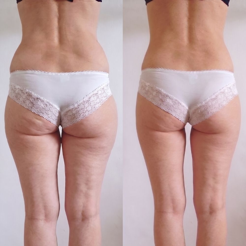 Body Shaping Anti-Cellulite & Hautstraffung