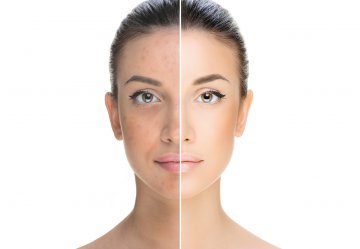 Anti-Akne Gesichtsbehandlung in Innsbruck - Before & After | INCEBEL Medical Beauty Institut