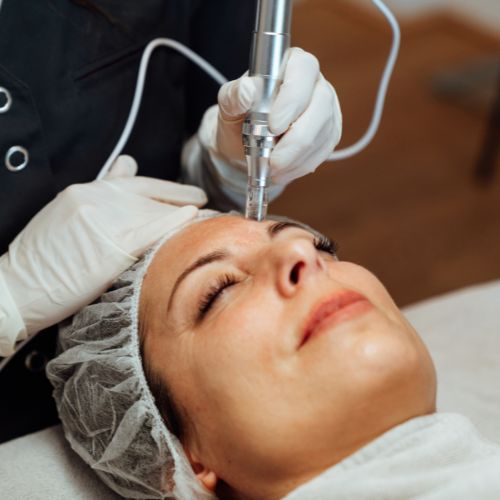 Skin Renew Microneedling